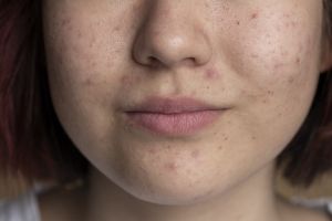 Tak perlu coba banyak skincare, ini cara efektif hilangkan tiny bumps di wajah dalam 10 menit