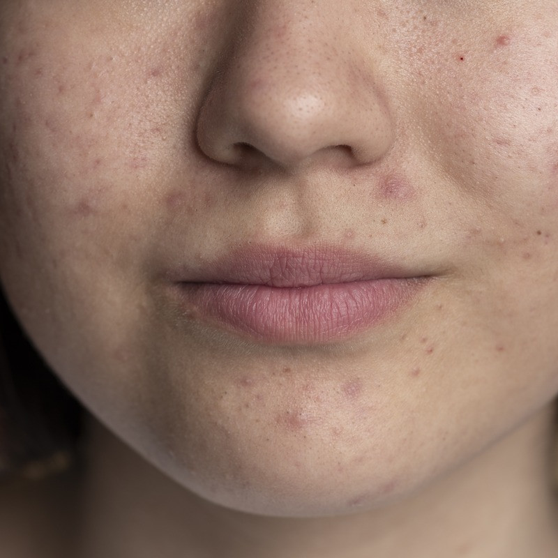 Tak perlu coba banyak skincare, ini cara efektif hilangkan tiny bumps di wajah dalam 10 menit