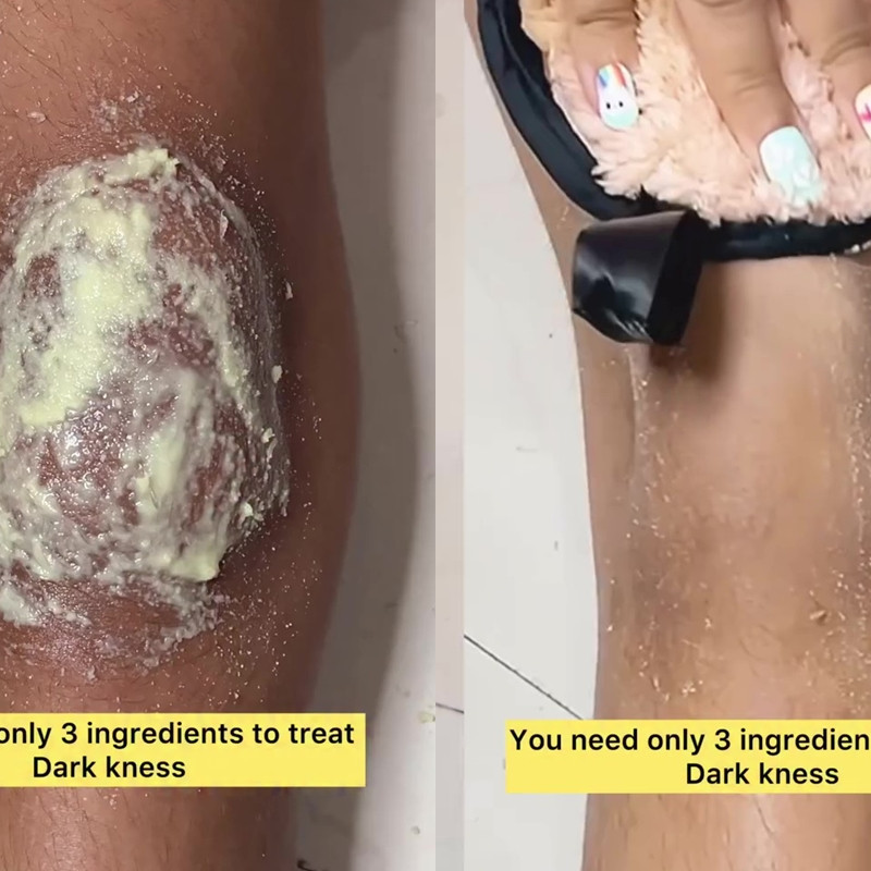 Lutut hitam dan kasar bukan lagi masalah, begini cara cepat mengatasinya dalam 20 menit