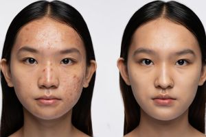 Bekas jerawat hilang dalam 7 hari, ini 3 cara skincare ampuh yang wajib kamu coba