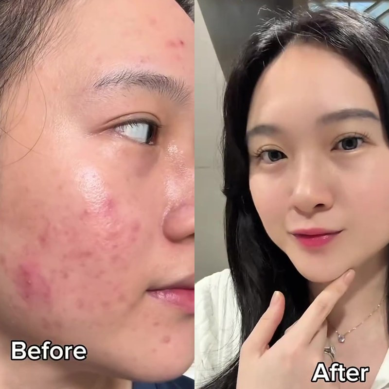 Tak perlu skincare mahal, cewek ini buktikan 1 bahan dapur bisa ampuh hilangkan jerawat dan bekasnya