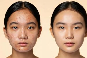 5 Cara menghilangkan jerawat dengan cepat dan aman, hasil terlihat sejak hari pertama