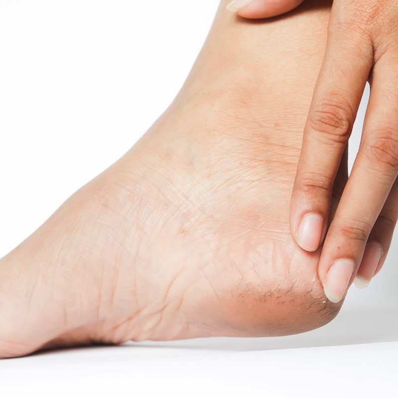 Solusi rumahan atasi tumit kasar, menebal, dan retak tanpa obat mahal, cukup rutin pakai campuran ini