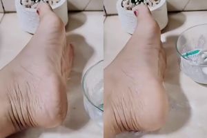 Tak perlu direndam air hangat, begini cara bikin tumit pecah-pecah jadi mulus cuma dengan 2 tanaman