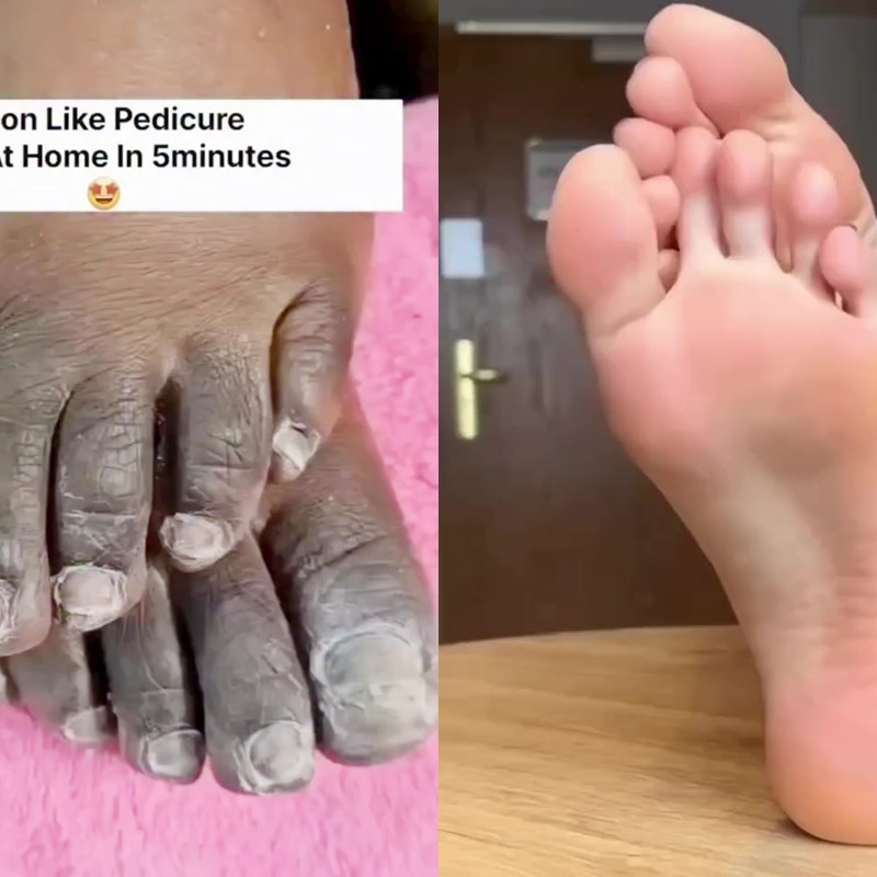 Modal 1 jenis rempah, begini cara mengatasi tumit hitam dan kasar agar mulus lagi bak perawatan salon