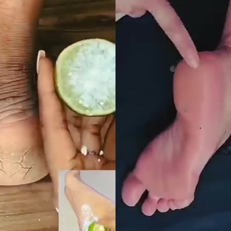 Jangan dikikis, scrub dari 2 bahan dapur ini ampuh bikin tumit pecah-pecah jadi mulus lagi
