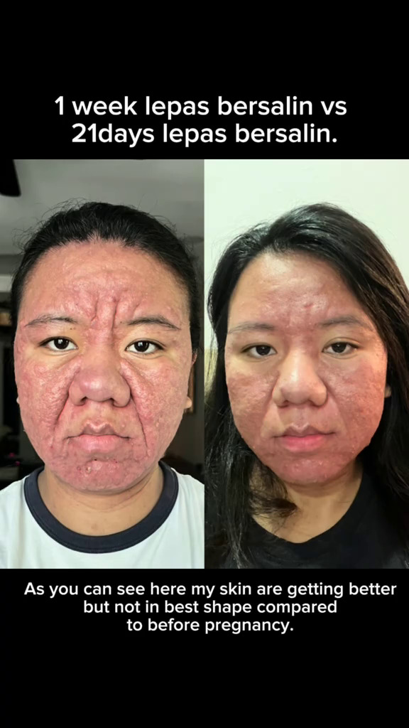 Wanita ini alami perubahan pada wajahnya saat hamil, usahanya berjuang untuk sembuh banjir simpati