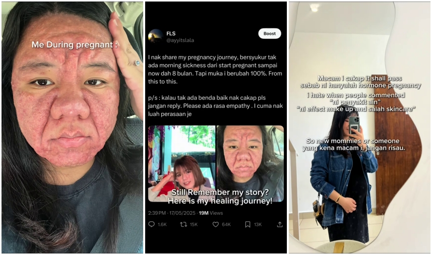 Wanita ini alami perubahan pada wajahnya saat hamil, usahanya berjuang untuk sembuh banjir simpati