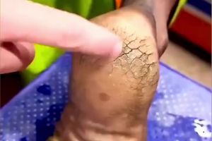 Cuma butuh semalam! Ini cara efektif hilangkan tumit pecah-pecah agar halus lagi dengan 2 bahan dapur