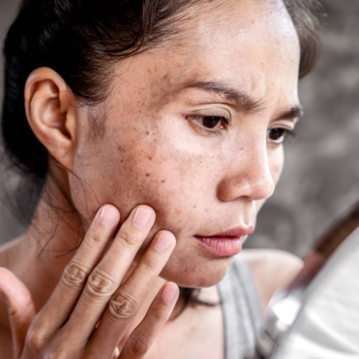 Nggak pede karena kulit belang? Ini cara agar wajah putih merata pakai 1 jenis bahan makanan