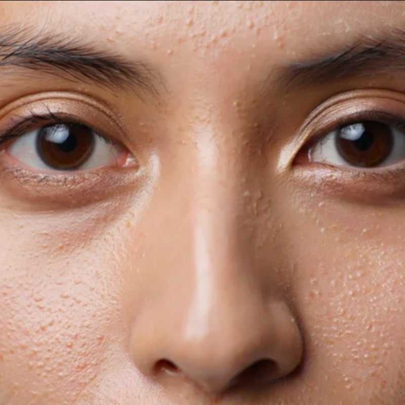 Pori-pori wajah terbuka? Coba 1 jenis protein ini untuk mengecilkannya secara aman tanpa perlu laser