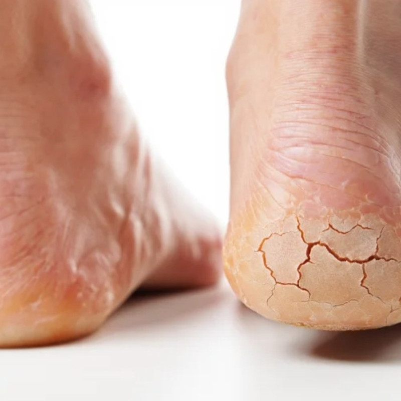 Tumit pecah-pecah bikin iritasi? Bahan pemanis ini bisa ampuh mengatasinya tanpa bikin perih