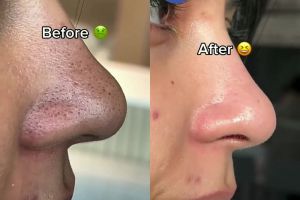 Pori-pori kotor penuh komedo hitam? Coba bersihkan dengan buah 1 ini, komedo auto hilang dalam sekejap