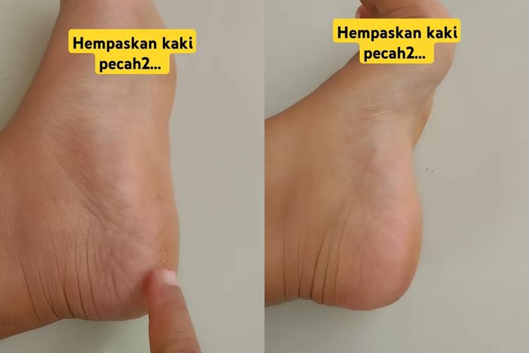 Tak ada lagi tumit kasar dan pecah-pecah, ini trik ampuh menghempaskannya dengan 1 bumbu dapur