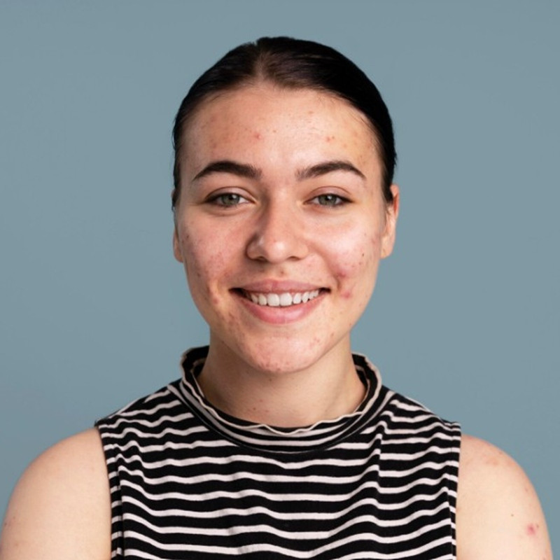 Wajah breakout dan kusam? Begini cara ampuh mengatasinya agar lebih cerah tanpa skincare mahal