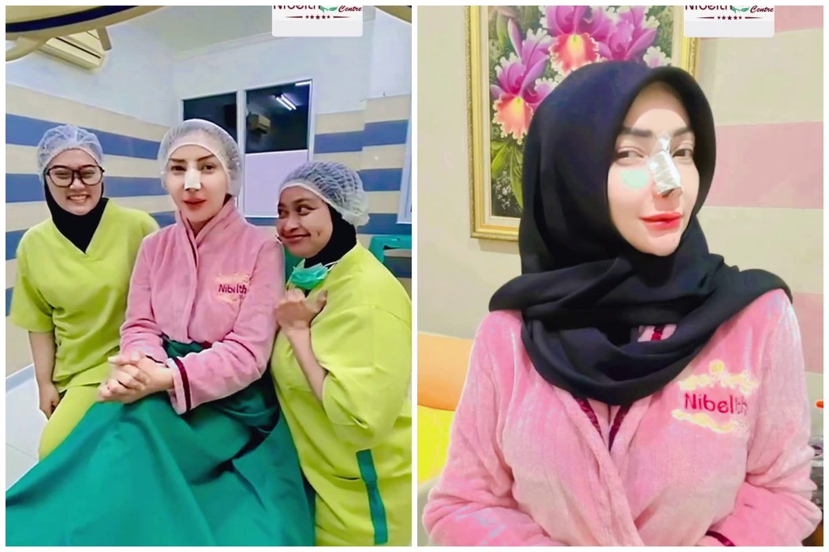 7 Potret Roro Fitria jalani operasi plastik hidung, ngaku demi kesehatan