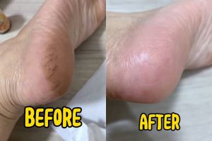 Tumit pecah-pecah bikin kaki perih? Coba haluskan dengan buah ini biar mulus lagi, bahannya sederhana