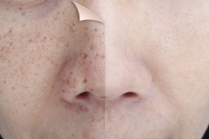 Tepung ini ampuh pudarkan flek hitam akibat hiperpigmentasi meski tanpa yoghurt, caranya mudah banget