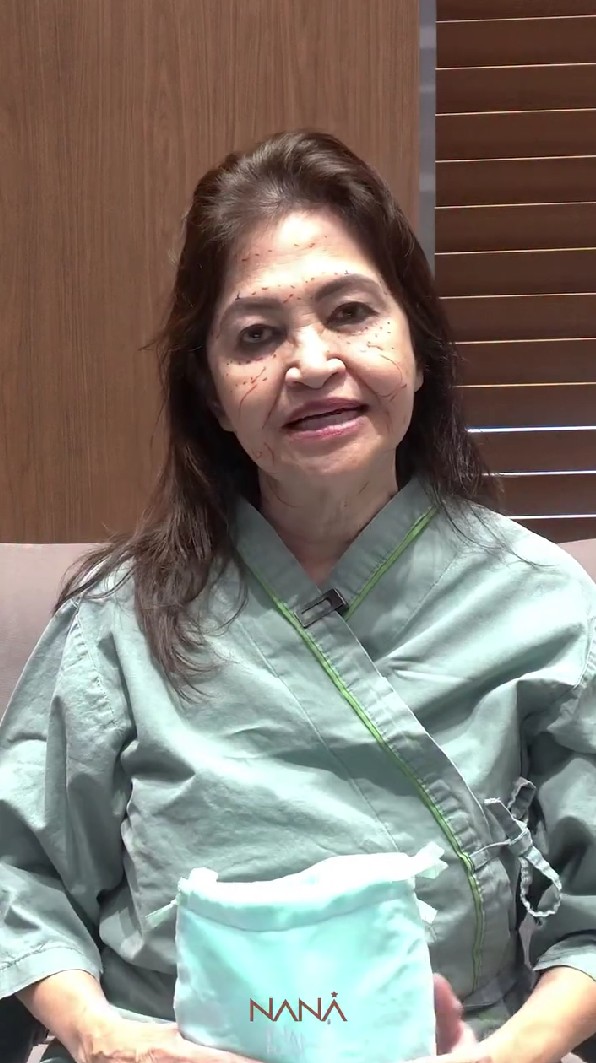 Wajah kendur di usia 65, ibunda Nia Ramadhani oplas di Korea Selatan, ini 7 potretnya sebelum tindakan