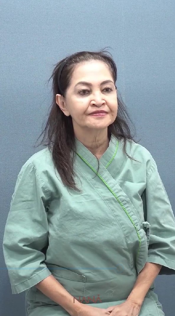 Wajah kendur di usia 65, ibunda Nia Ramadhani oplas di Korea Selatan, ini 7 potretnya sebelum tindakan