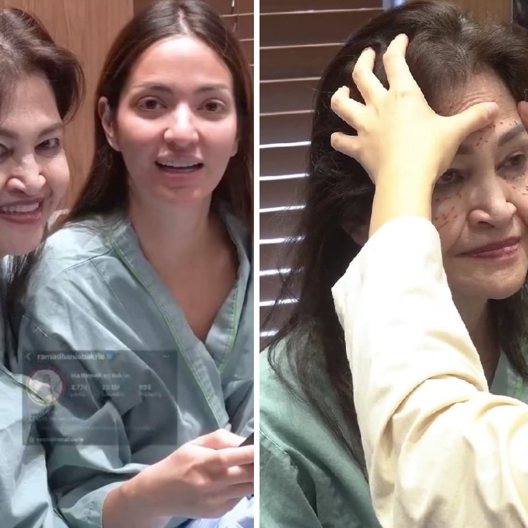 Wajah kendur di usia 65, ibunda Nia Ramadhani oplas di Korea Selatan, ini 7 potretnya sebelum tindakan