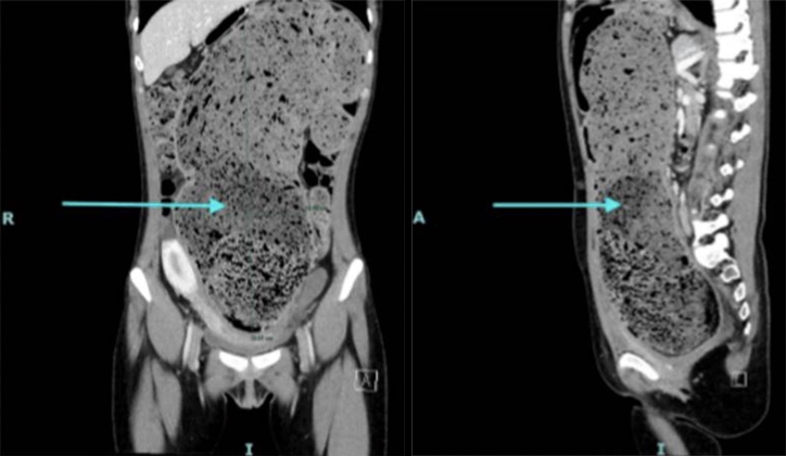 Kisah wanita tak BAB 4 bulan, dokter ungkap kondisi perutnya bak dipenuhi tanah liat