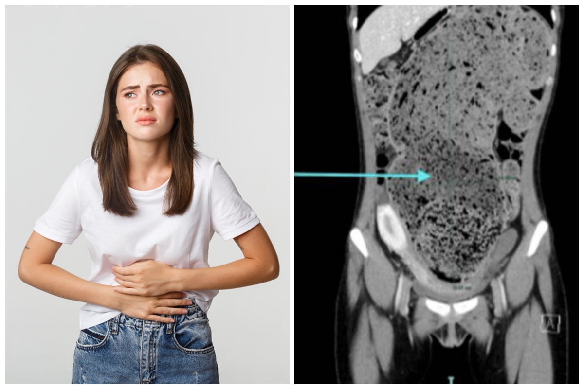 Kisah wanita tak BAB 4 bulan, dokter ungkap kondisi perutnya bak dipenuhi tanah liat