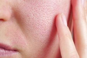 Pori-pori kulit tak tersumbat lagi, pakai 1 sumber protein, nggak harus pakai air mawar