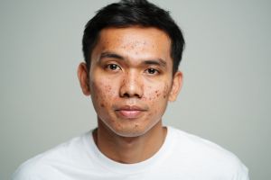 10 Skincare cowok penghilang bekas jerawat harga di bawah Rp 100 ribu