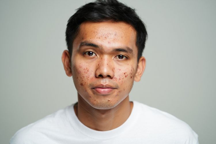 10 Skincare cowok penghilang bekas jerawat harga di bawah Rp 100 ribu