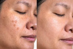 Flek hitam mengganggu penampilan? Coba pakai 1 bumbu dapur ini buat bikin wajah jadi cerah alami