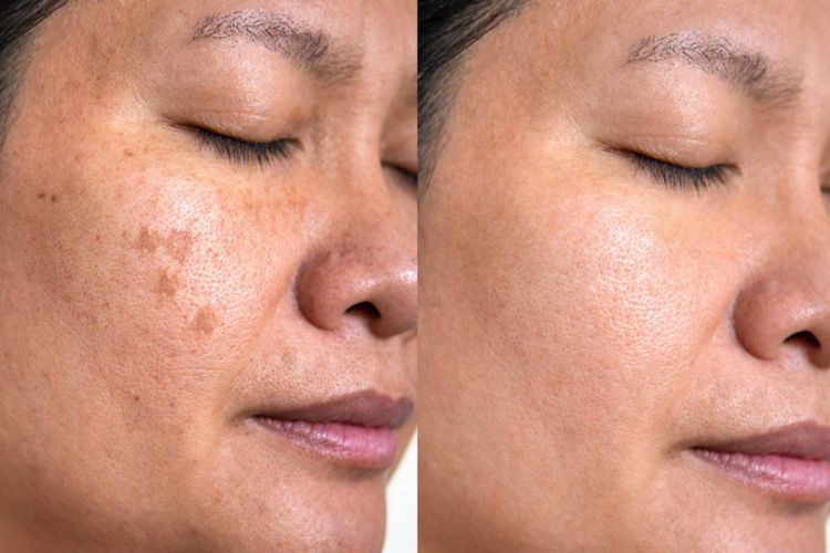 Flek hitam mengganggu penampilan? Coba pakai 1 bumbu dapur ini buat bikin wajah jadi cerah alami