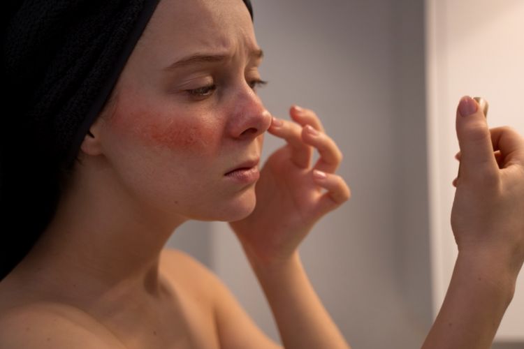 9 Cara mengatasi kurap di wajah tanpa bahan kimia, bisa gunakan kunyit hingga minyak serai