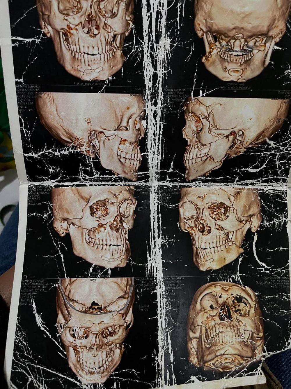 Kini kembali mencuat, ini 6 kronologi kasus tabrak lari yang menyerat Nadya Almira 13 tahun lalu