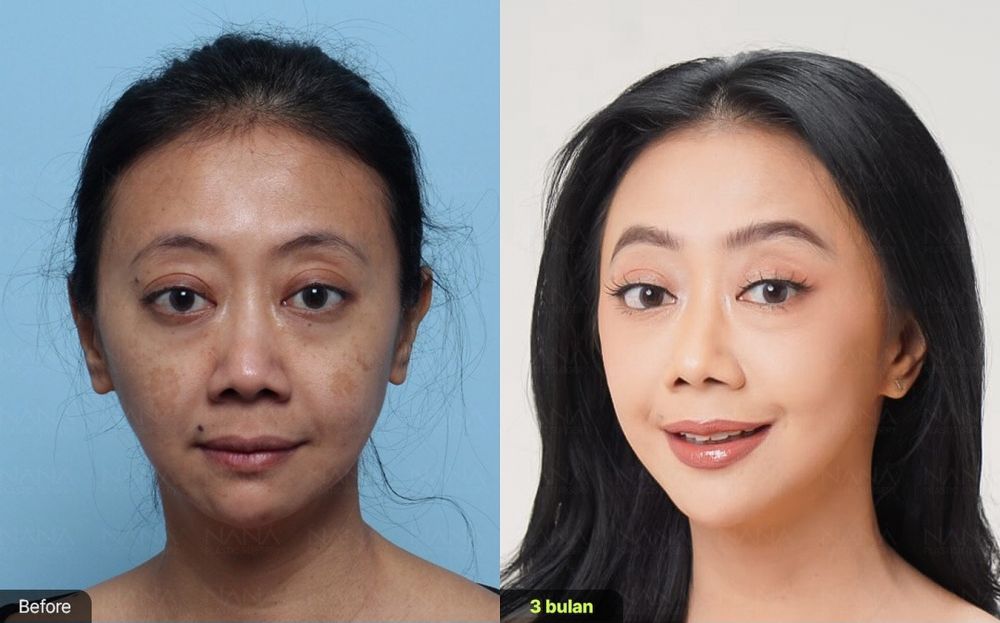 Tak malu akui oplas, Asri welas bagikan potret sebelum dan sesudah operasi anti-aging, dipuji natural