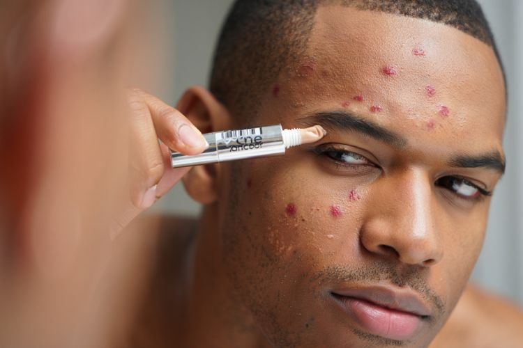 10 Concealer cowok harga di bawah Rp150 ribu, ampuh tutupi jerawat dan bekasnya dengan hasil natural