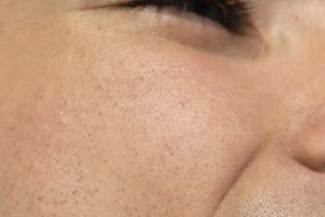 7 cara simpel hilangkan strawberry skin biar kulit kaki halus lagi tanpa bintik hitam