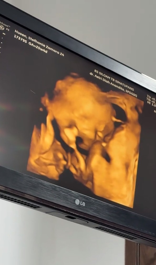 9 Potret Steffi Zamora cek kandungan ditemani Nino Fernandez, foto USG-nya bikin salfok