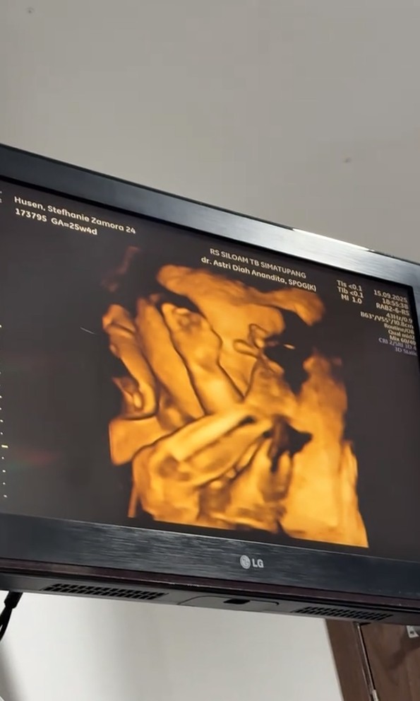 9 Potret Steffi Zamora cek kandungan ditemani Nino Fernandez, foto USG-nya bikin salfok