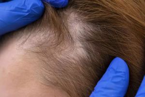 Rambut pitak bikin penampilan jelek? Ini cara menumbuhkannya tanpa hair tonic, pakai 2 bumbu dapur