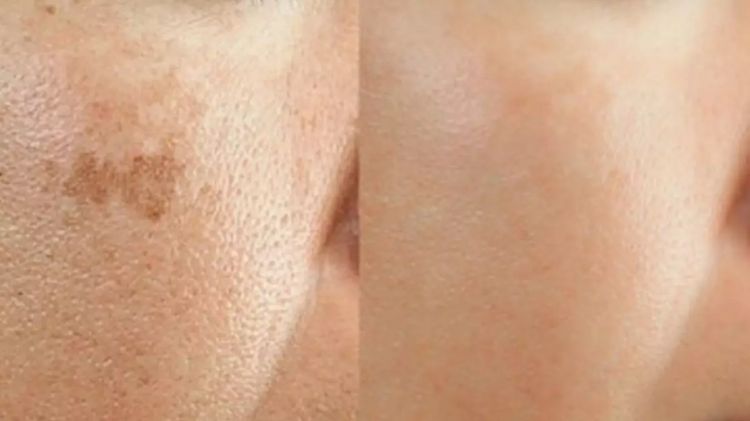 Wajah jadi cerah tanpa scrub, gunakan 2 jenis minuman ini untuk atasi flek hitam dan kusam