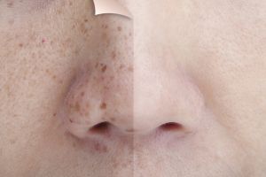 Tak perlu treatment laser, ini trik atasi flek hitam pakai kunyit dicampur 2 bahan alami, auto cerah
