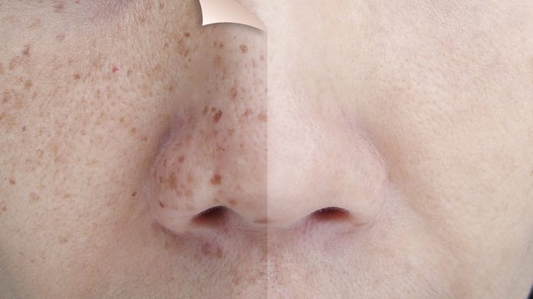 Tak perlu treatment laser, ini trik atasi flek hitam pakai kunyit dicampur 2 bahan alami, auto cerah