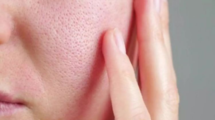 Tak banyak yang tahu, bunga ini ampuh kecilkan pori-pori wajah dan kulit nggak berminyak, ini caranya