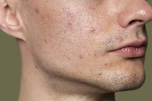 10 Skincare cowok penghilang bekas jerawat terbaru harga di bawah Rp 150 ribu