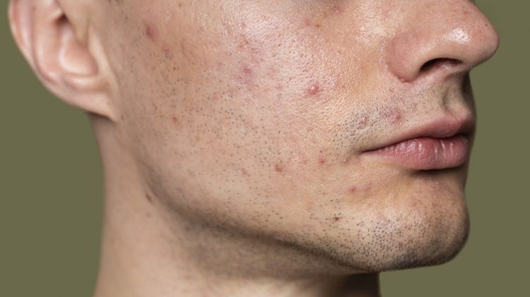 10 Skincare cowok penghilang bekas jerawat terbaru harga di bawah Rp 150 ribu