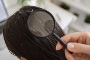 Trik menghilangkan kutu rambut simpel pakai 2 bahan alami, efektif dan praktis