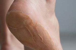 Lilin ditambah 2 jenis buah ini ternyata bisa bikin tumit kasar jadi bebas pecah-pecah, ini caranya