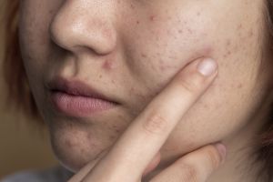 10 Krim pagi menghilangkan bruntusan di pipi harga di bawah Rp 100 ribu