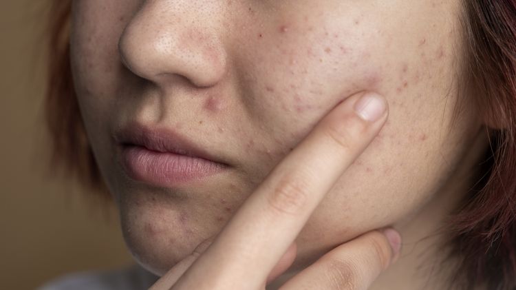 10 Krim pagi menghilangkan bruntusan di pipi harga di bawah Rp 100 ribu